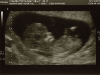 12 Week Scan, Image 2