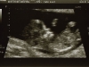 12 Week Scan, Image 1