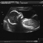 20 Week Scan