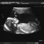 20 Week Scan